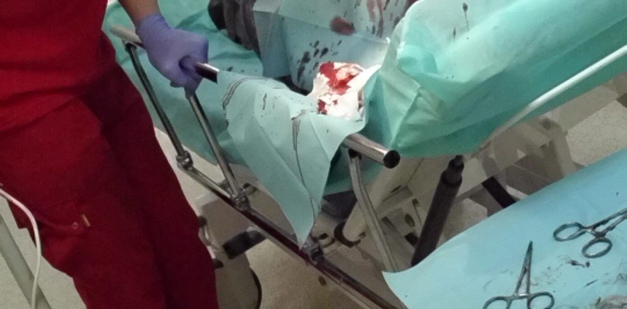 Wytrzewienie. Przypadek kliniczny nr 22